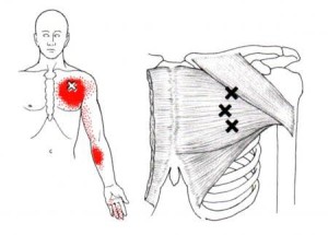 trigger-point1